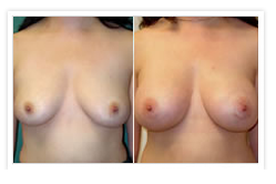 Breast Augmentation Before & After Photos