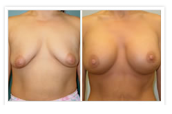 Breast Augmentation Before & After Photos