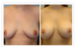 Breast Augmentation Before & After Photos