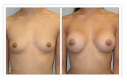 Breast Augmentation Before & After Photos