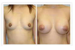 Breast Augmentation Before & After Photos