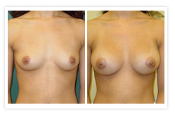 Breast Augmentation Before & After Photos