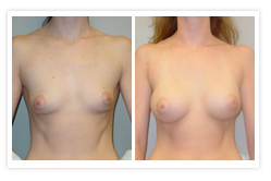 Breast Augmentation Before & After Photos