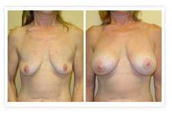 Breast Augmentation Before & After Photos