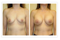 Breast Augmentation Before & After Photos