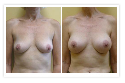 Breast Augmentation Before & After Photos