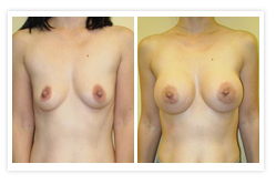 Breast Augmentation Before & After Photos