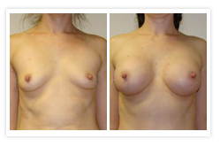 Breast Augmentation Before & After Photos