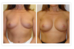 Breast Augmentation Before & After Photos