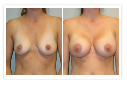 Breast Augmentation Before & After Photos