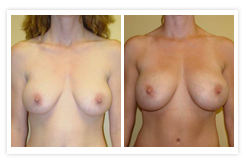 Breast Augmentation Before & After Photos