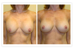 Breast Augmentation Before & After Photos