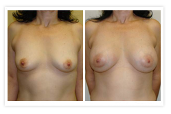 Breast Augmentation Before & After Photos