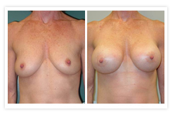 Breast Augmentation Before & After Photos