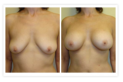 Breast Augmentation Before & After Photos