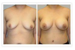 Breast Augmentation Before & After Photos