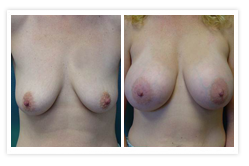 Breast Augmentation Before & After Photos