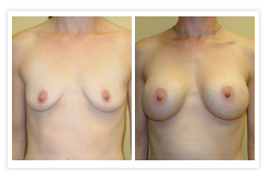 Breast Augmentation Before & After Photos