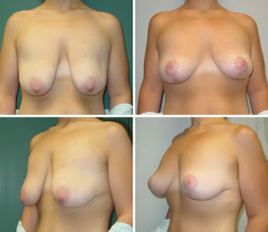 Breast Lift Before & After Photos