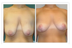 Breast Lift Before & After Photos