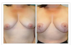 Breast Lift Before & After Photos