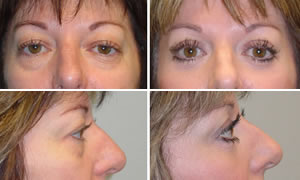 Blepharoplasty Before & After Photos