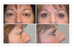 Blepharoplasty Before & After Photos