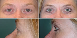 Blepharoplasty Before & After Photos