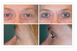 Blepharoplasty Before & After Photos