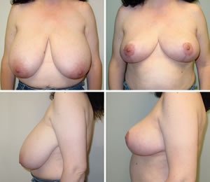 Breast Reduction Before & After Photos