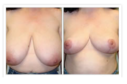 Breast Reduction Before & After Photos