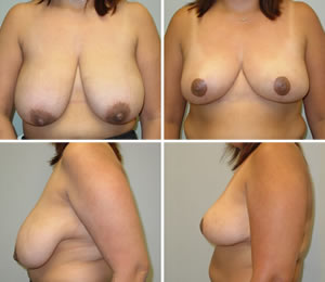 Breast Reduction Before & After Photos