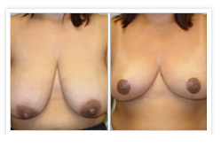 Breast Reduction Before & After Photos