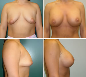 Breast Augmentation Before & After Photos