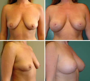 Breast Augmentation Before & After Photos