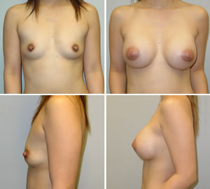 Breast Augmentation Before & After Photos