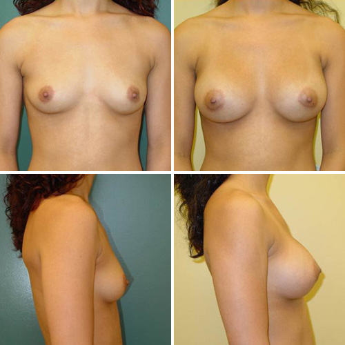 Breast Augmentation Before & After Photos