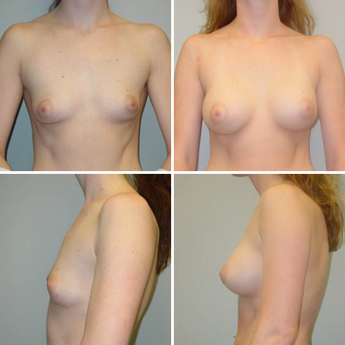 Breast Augmentation Before & After Photos