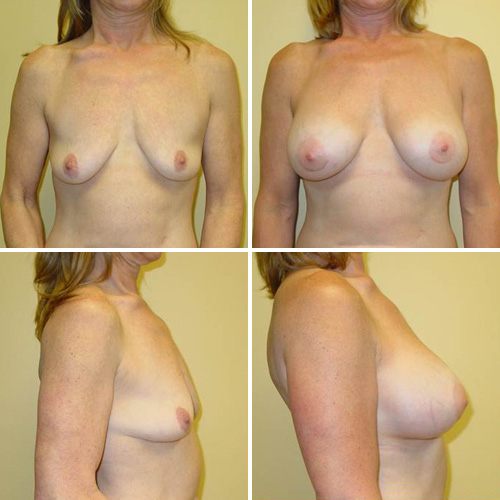 Breast Augmentation Before & After Photos