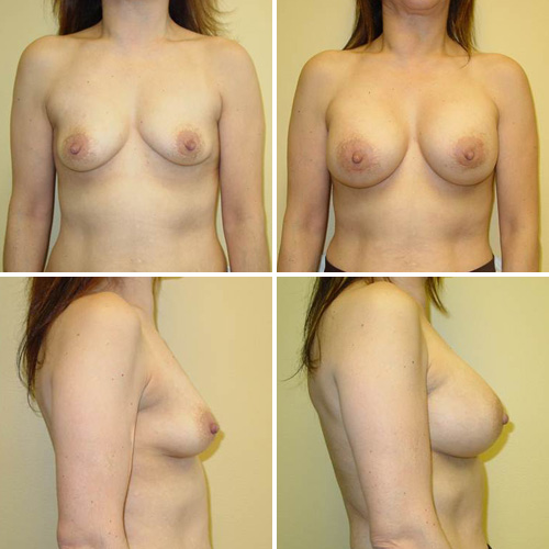 Breast Augmentation Before & After Photos