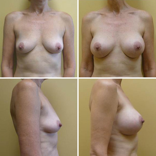 Breast Augmentation Before & After Photos