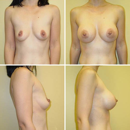 Breast Augmentation Before & After Photos