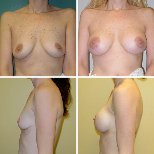 Breast Augmentation Before & After Photos