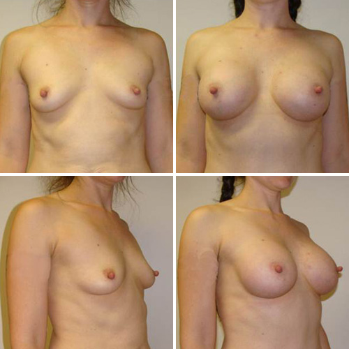 Full Size C Cup Breast Implants Photos - Dr. Piro