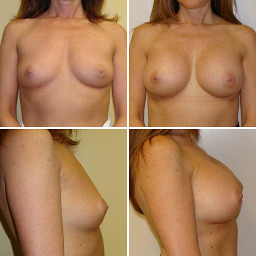 Breast Augmentation Before & After Photos