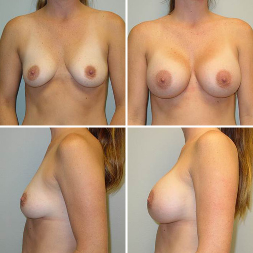 Breast Augmentation Before & After Photos