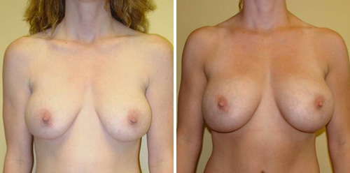 Breast Augmentation Before & After Photos