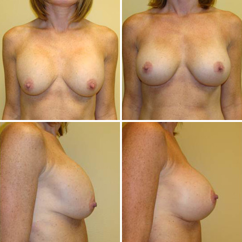 Breast Augmentation Before & After Photos