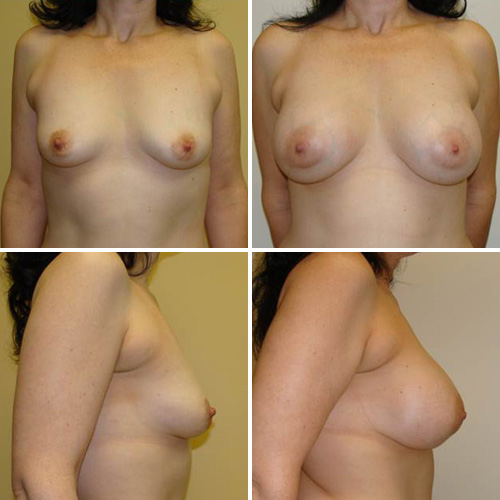 Breast Augmentation Before & After Photos