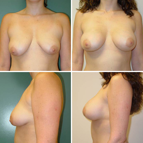 Breast Augmentation Before & After Photos